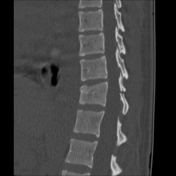 Chance fracture (Radiopaedia 36521-38081 Sagittal bone window 39).jpg