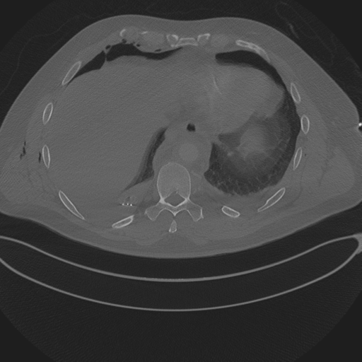 Chest multitrauma - aortic injury (Radiopaedia 34708-36147 Axial bone window 230).png