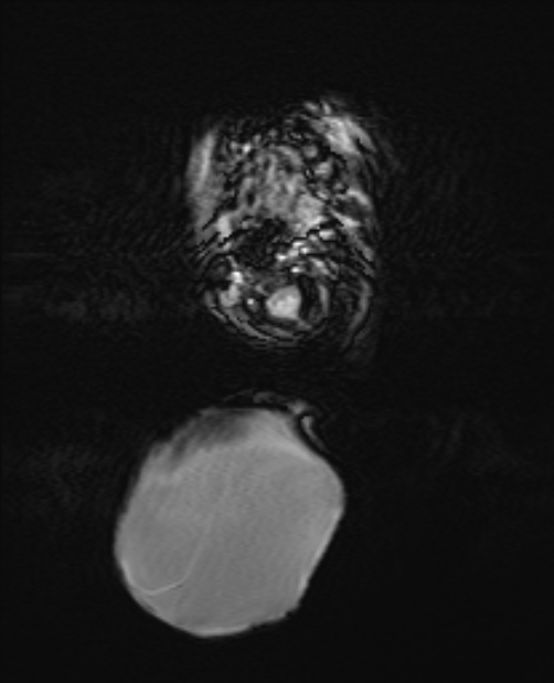 Chiari III malformation with occipital encephalocele (Radiopaedia 79446-92559 Axial SWI 14).jpg
