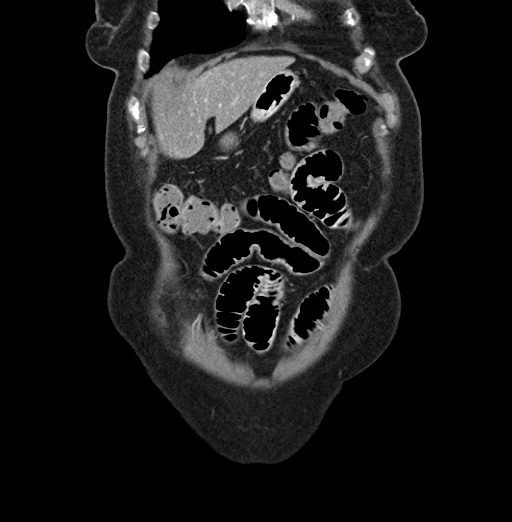 File:Cholecystoduodenal fistula due to calculous cholecystitis with gallstone migration (Radiopaedia 86875-103077 B 9).jpg