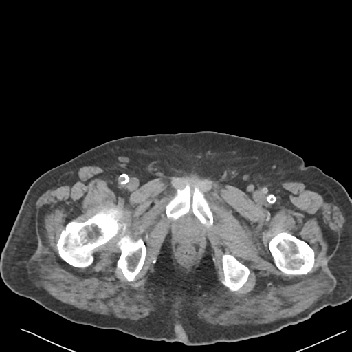 File:Choledocholithiasis and gastric polyp (Radiopaedia 48856-53895 Axial non-contrast 90).png