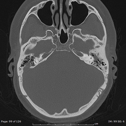 Cholesteatoma - external auditory canal (Radiopaedia 88452-105096 Axial bone window 62).jpg