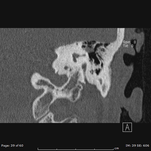 File:Cholesteatoma - external auditory canal (Radiopaedia 88452-105096 Coronal bone window 39).jpg