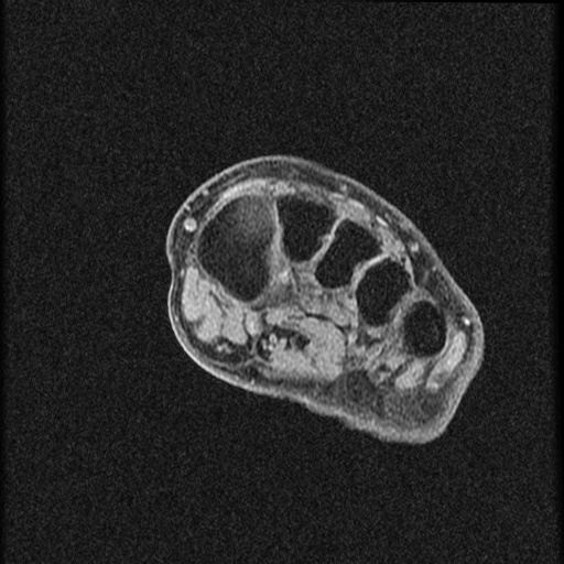 File:Chondroblastoma - midfoot (Radiopaedia 64831-73765 F 19).jpg