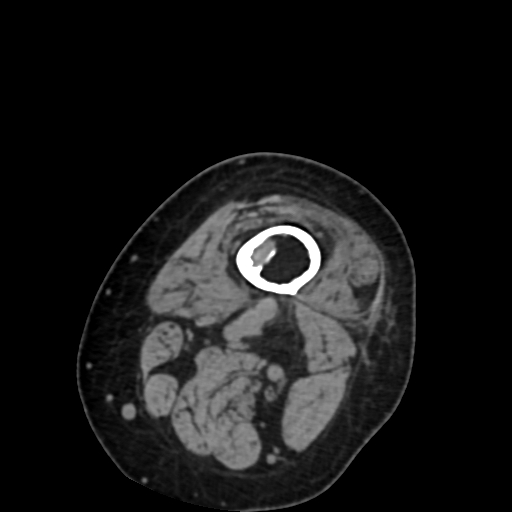 Chondrosarcoma - femur (Radiopaedia 64187-72954 Axial non-contrast 6).jpg