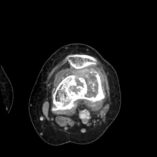 Chondrosarcoma - femur (Radiopaedia 64187-72954 Axial with contrast 40).jpg