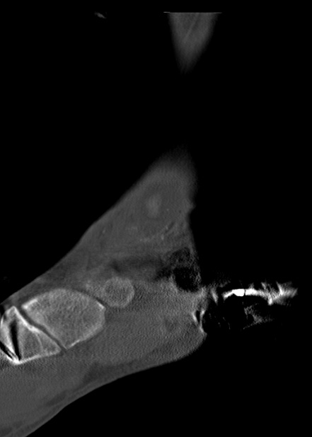 Chopart fracture (Radiopaedia 35347-36861 Sagittal bone window 27).jpg
