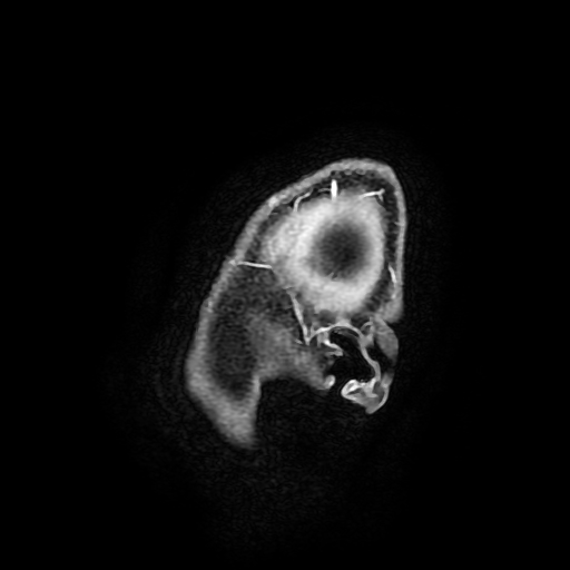 Chordoid glioma of third ventricle (Radiopaedia 91612-109340 F 15).jpg