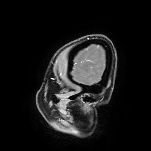 Chordoid glioma of third ventricle (Radiopaedia 91612-109340 F 28).jpg