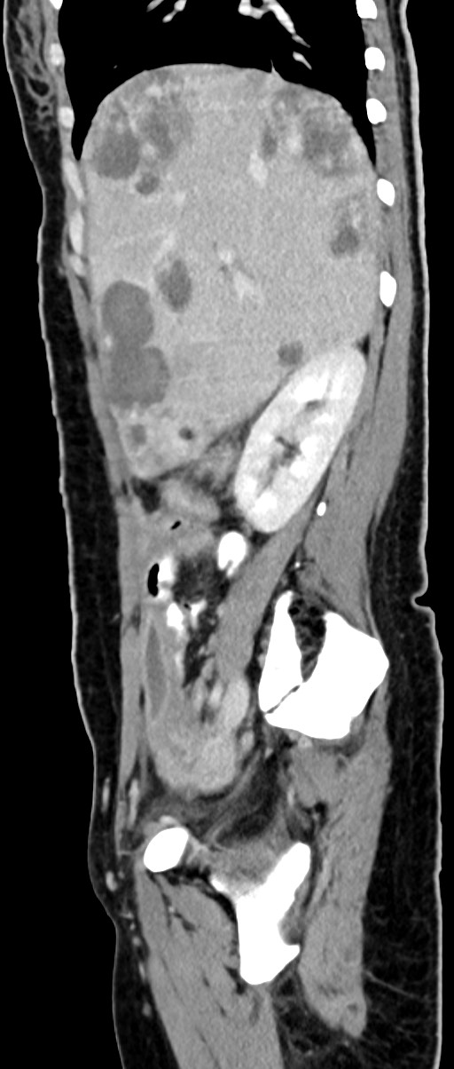 Choriocarcinoma liver metastases (Radiopaedia 74768-85766 C 122).jpg