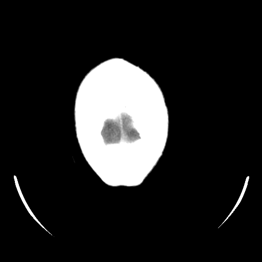 File:Choroid plexus papilloma (Radiopaedia 33040-34056 Axial non-contrast 28).png