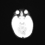 File:Choroid plexus papilloma (Radiopaedia 84612-100019 Axial DWI 10).jpg