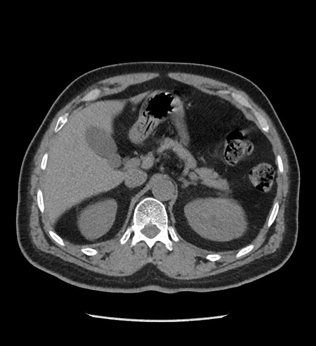 Chromophobe renal cell carcinoma (Radiopaedia 86879-103083 Axial non-contrast 20).jpg