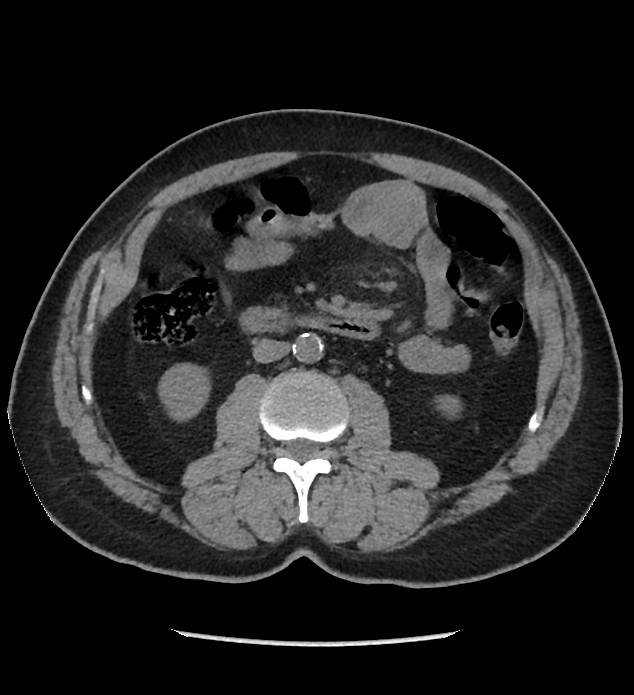 Chromophobe renal cell carcinoma (Radiopaedia 86879-103083 Axial non-contrast 50).jpg