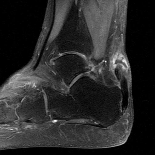 File:Chronic Achilles tendon rupture (Radiopaedia 15262-15100 C 5).jpg