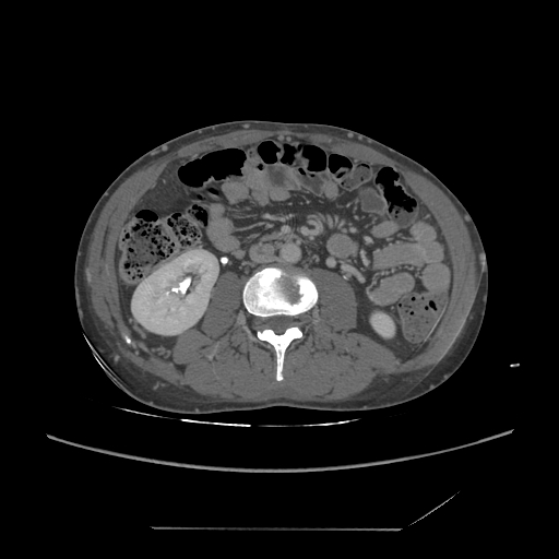 File:Chronic IVC thrombosis and resultant IVC filter malposition (Radiopaedia 81158-94800 A 111).jpg