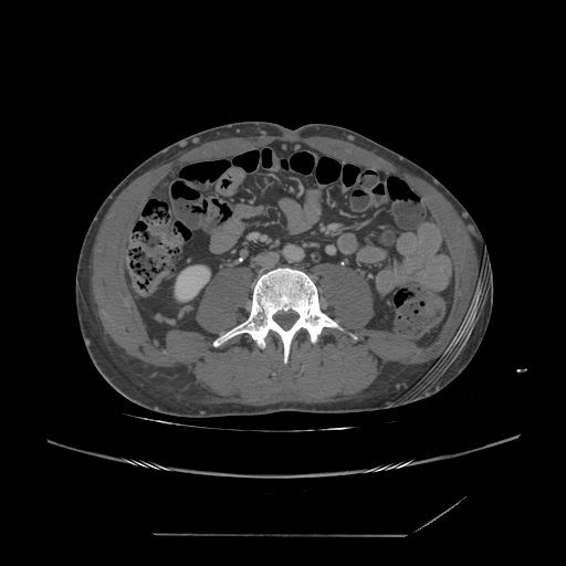 File:Chronic IVC thrombosis and resultant IVC filter malposition (Radiopaedia 81158-94800 A 131).jpg