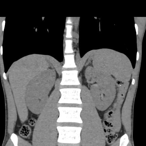 File:Chronic calcific pancreatitis (Radiopaedia 56280-62953 Coronal non-contrast 22).jpg