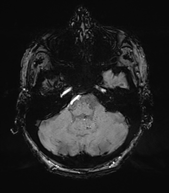 Chronic hypertensive encephalopathy (Radiopaedia 39993-42482 Axial SWI 18).png