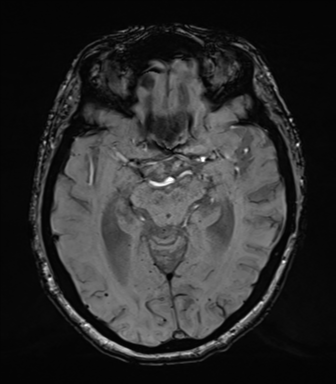 Chronic hypertensive encephalopathy (Radiopaedia 39993-42482 Axial SWI 37).png