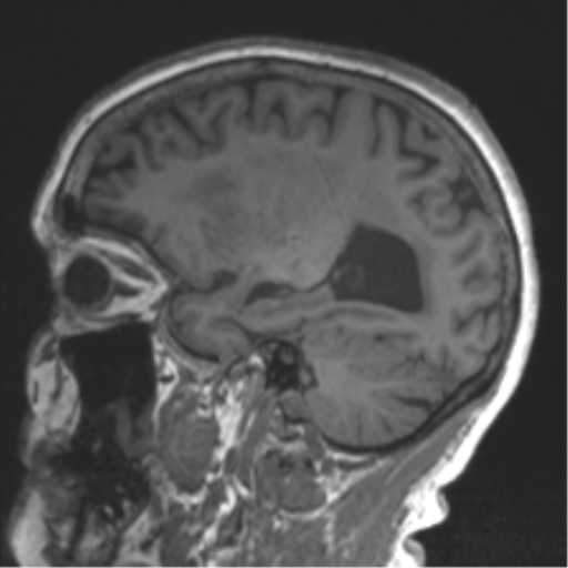 Chronic hypertensive encephalopathy (Radiopaedia 39993-42482 Sagittal T1 62).png