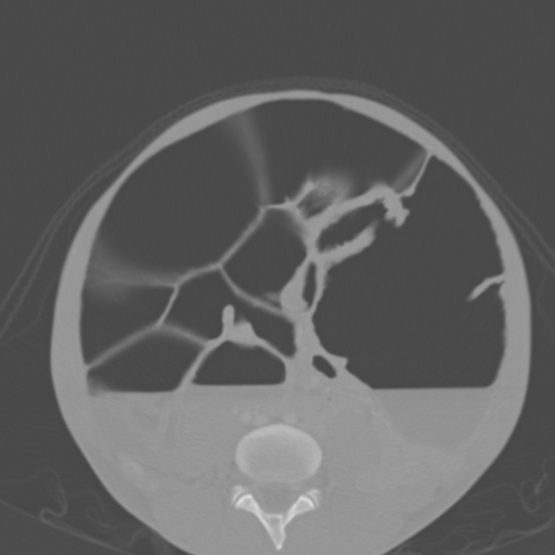 Chronic large bowel pseudo-obstruction (Radiopaedia 43181-46492 Axial bone window 115).jpg