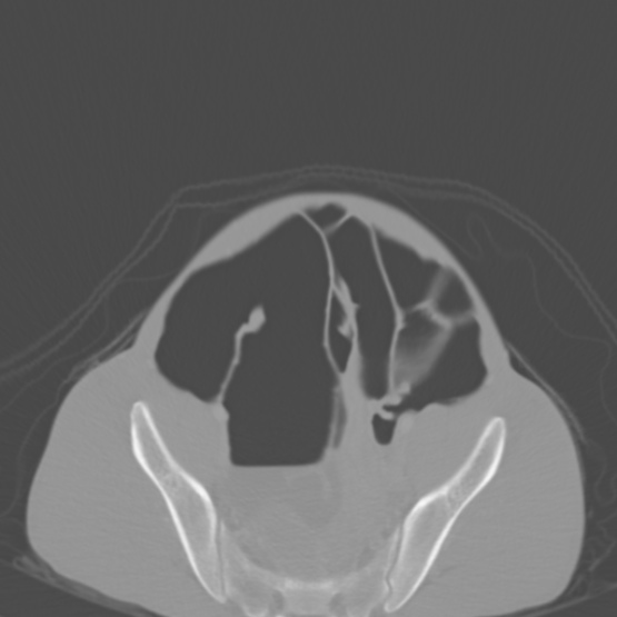 Chronic large bowel pseudo-obstruction (Radiopaedia 43181-46492 Axial bone window 139).jpg