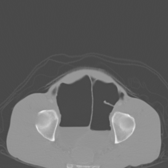 Chronic large bowel pseudo-obstruction (Radiopaedia 43181-46492 Axial bone window 149).jpg