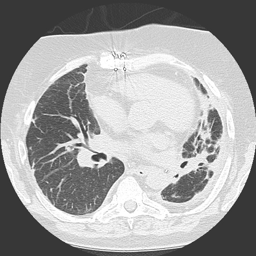 Chronic lung allograft dysfunction - restrictive form (Radiopaedia 60595-68316 Axial lung window 36).jpg