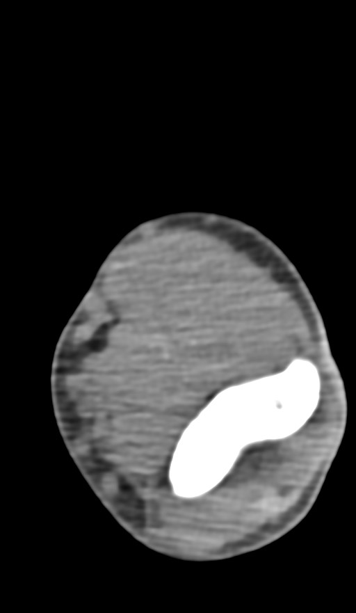 Chronic osteomyelitis of the distal humerus (Radiopaedia 78351-90971 Axial non-contrast 84).jpg