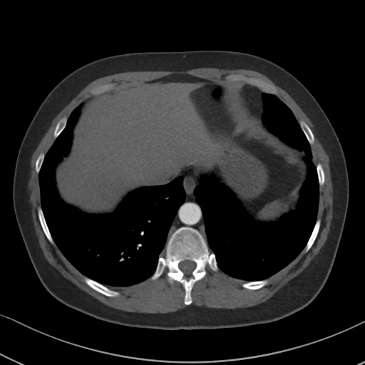 Chronic pulmonary embolus (Radiopaedia 39129-41341 Axial C+ CTPA 83).png