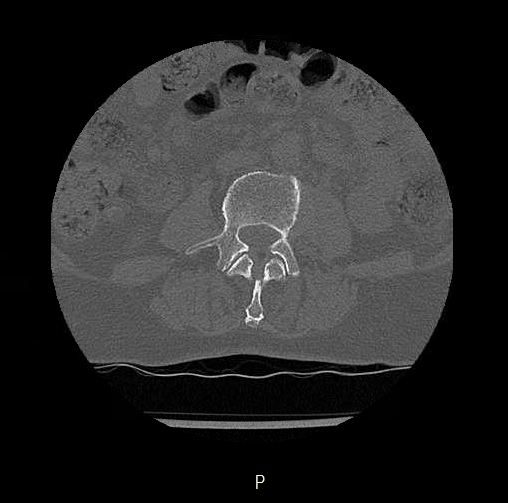 Chronic spinal hematoma with cauda equina syndrome (Radiopaedia 75745-88197 Axial bone window 15).png