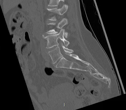 File:Chronic spinal hematoma with cauda equina syndrome (Radiopaedia 75745-88197 Sagittal bone window 11).png
