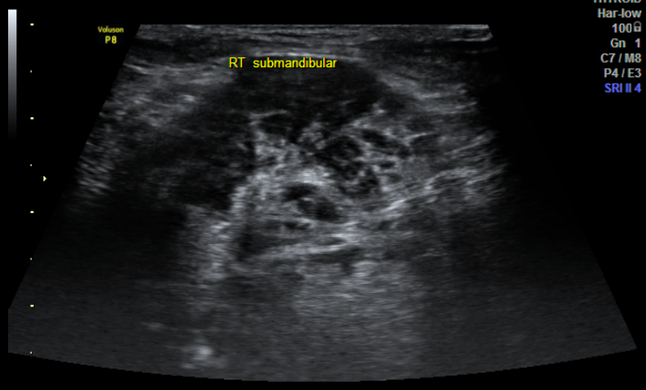 File:Chronic submandibular sialadenitis (Radiopaedia 61852-69883 Longitudinal 1).png