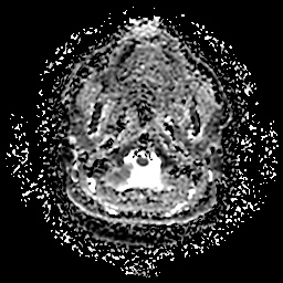 File:Chronic submandibular sialadenitis (Radiopaedia 61852-69885 Axial ADC 8).jpg