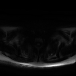Chronic submandibular sialadenitis (Radiopaedia 61852-69885 Axial DWI 29).jpg