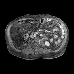 Cirrhosis and hepatocellular carcinoma in the setting of hemochromatosis (Radiopaedia 75394-86594 Axial T1 C+ fat sat 264).jpg