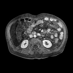Cirrhosis and hepatocellular carcinoma in the setting of hemochromatosis (Radiopaedia 75394-86594 Axial T1 C+ fat sat 272).jpg