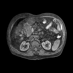 Cirrhosis and hepatocellular carcinoma in the setting of hemochromatosis (Radiopaedia 75394-86594 Axial T1 C+ fat sat 28).jpg