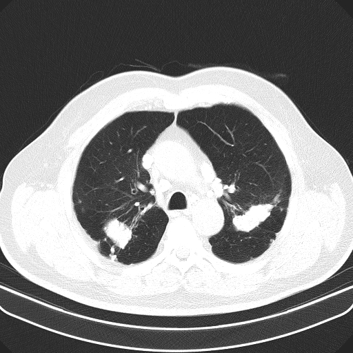 File:Classic complicated silicosis (Radiopaedia 49720-54961 Axial lung window 18).jpg