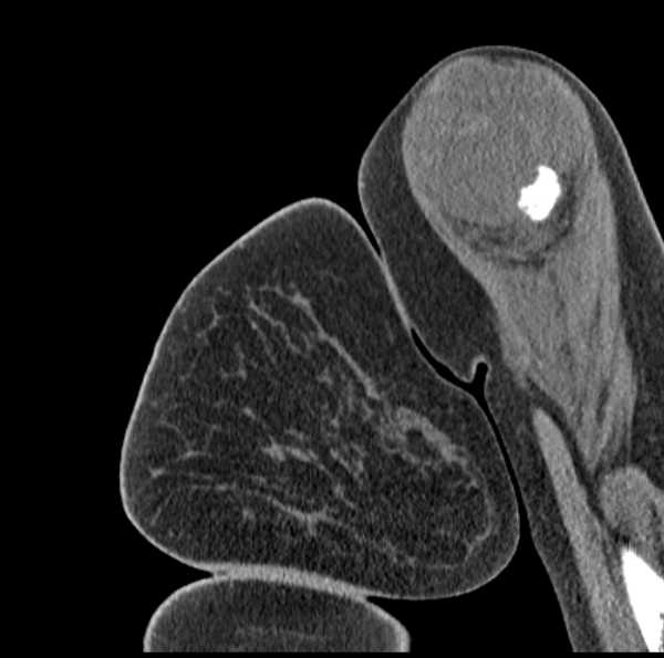 Clear cell chondrosarcoma - humerus (Radiopaedia 63104-71612 D 12).jpg