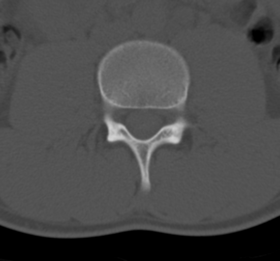 Clear cell meningoma - lumbar spine (Radiopaedia 60116-67691 Axial bone window 40).png