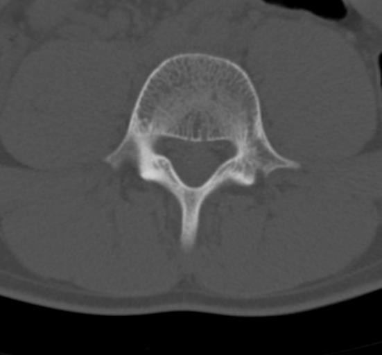 Clear cell meningoma - lumbar spine (Radiopaedia 60116-67691 Axial bone window 50).png