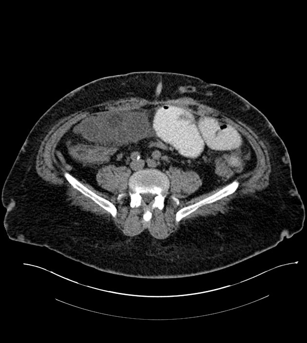 Closed-loop small bowel obstruction-internal hernia (Radiopaedia 78439-91096 Axial non-contrast 103).jpg