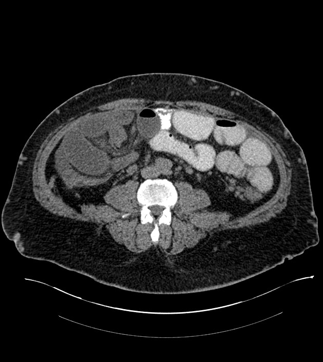 Closed-loop small bowel obstruction-internal hernia (Radiopaedia 78439-91096 Axial non-contrast 92).jpg