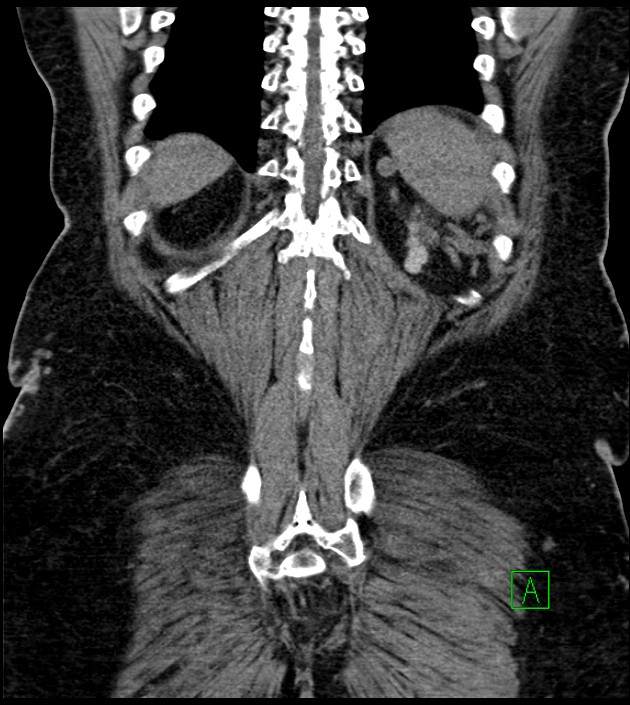 Closed-loop small bowel obstruction-internal hernia (Radiopaedia 78439-91096 Coronal non-contrast 85).jpg
