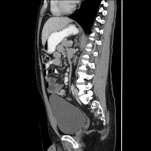 Closed-loop small bowel obstruction (Radiopaedia 73713-84509 B 98).jpg