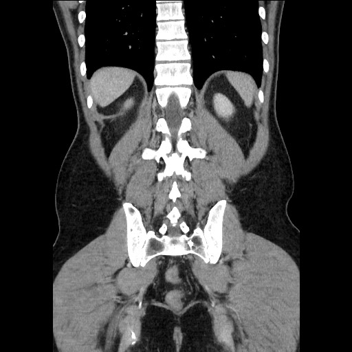 Closed-loop small bowel obstruction (Radiopaedia 73713-84509 C 97).jpg