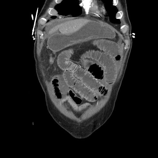 File:Closed loop obstruction due to adhesive band, resulting in small bowel ischemia and resection (Radiopaedia 83835-99023 C 27).jpg