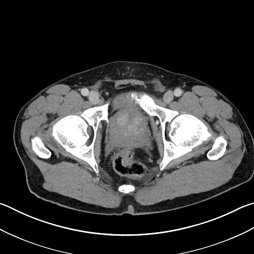 File:Closed loop small bowel obstruction - internal hernia (Radiopaedia 57806-64778 Axial 94).jpg